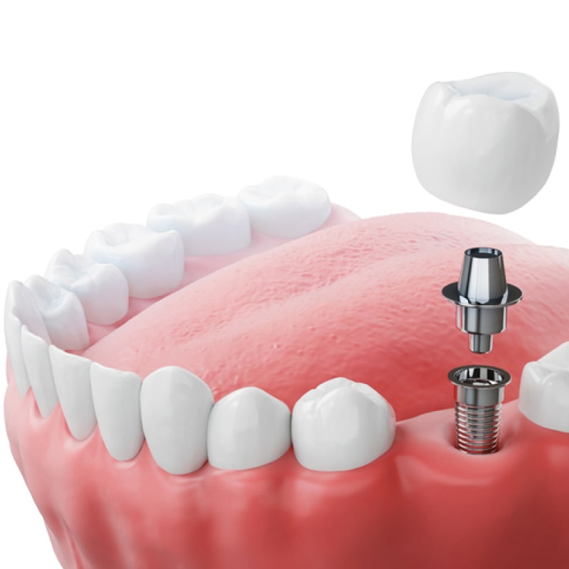Dental Procedure