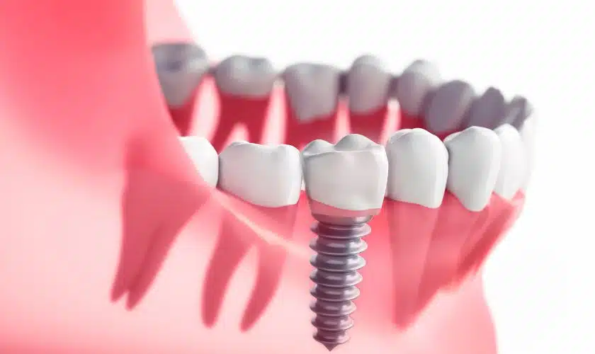 Dental Procedure